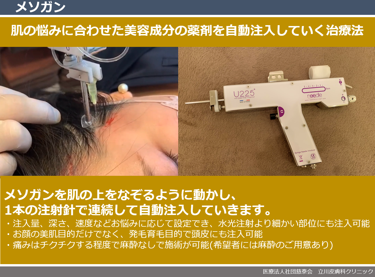 超歓迎された 新メニュー メソガン✨ ｜立川皮膚科クリニック｜ニキビ、シミ ボディ・フェイスケア