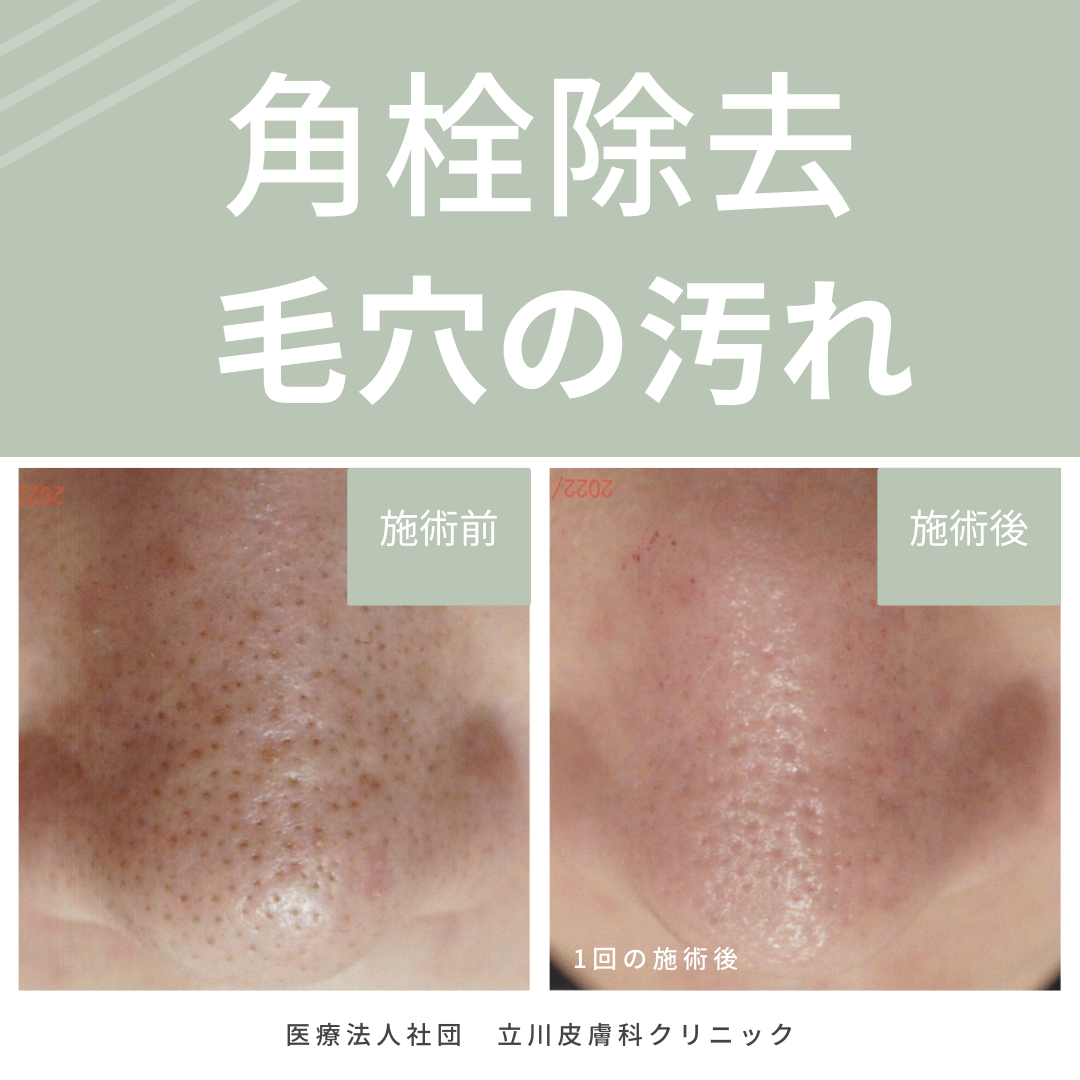 角栓 ニキビ に なる – 角栓 顕微鏡 – MKWJD