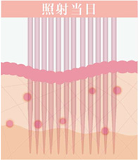照射当日