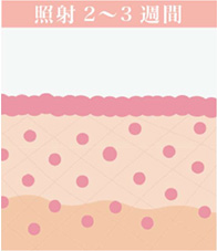 照射2～3週間