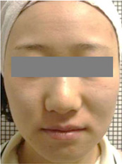 施術後、ダウンタイムの変化