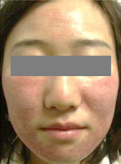 施術後、ダウンタイムの変化