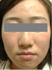 施術後、ダウンタイムの変化