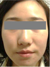 施術後、ダウンタイムの変化