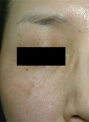 汗管腫・小じわ・タイトニング