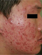 ニキビ・ニキビ跡