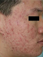 ニキビ・ニキビ跡