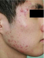 ニキビ・ニキビ跡