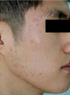 ニキビ・ニキビ跡