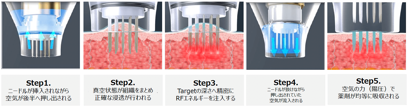 薬剤を均一に浸透させて治療を効果高めるドラッグデリバリーシステム